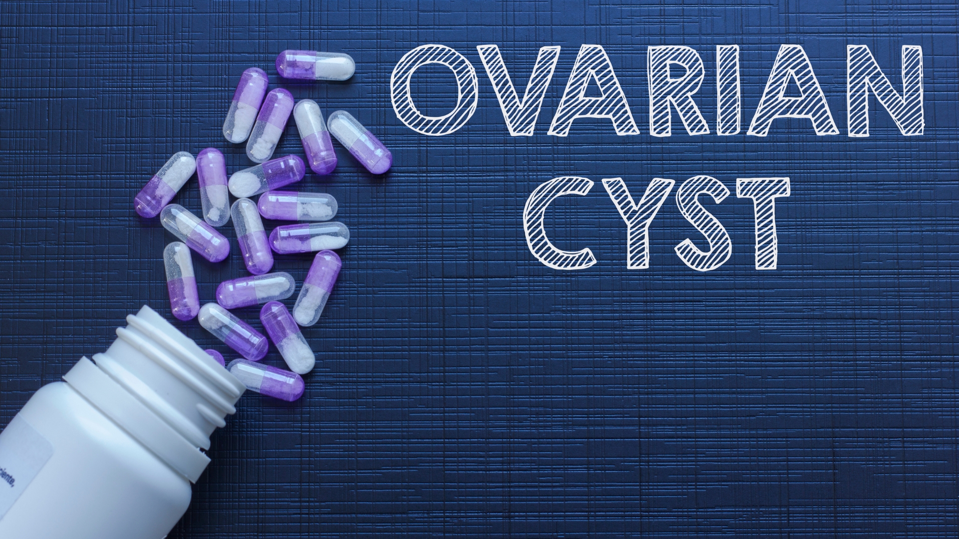 Ovarian cyst